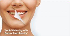 h-a-teeth-whitening-guaranteed-300x156