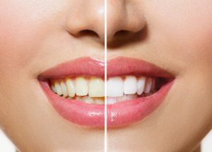 stock-photo-woman-teeth-before-and-after-whitening-over-white-background-happy-smiling-woman-dental-health-167843159-2-300x216