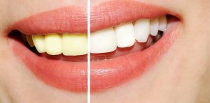 teeth-whitening-review-300x148